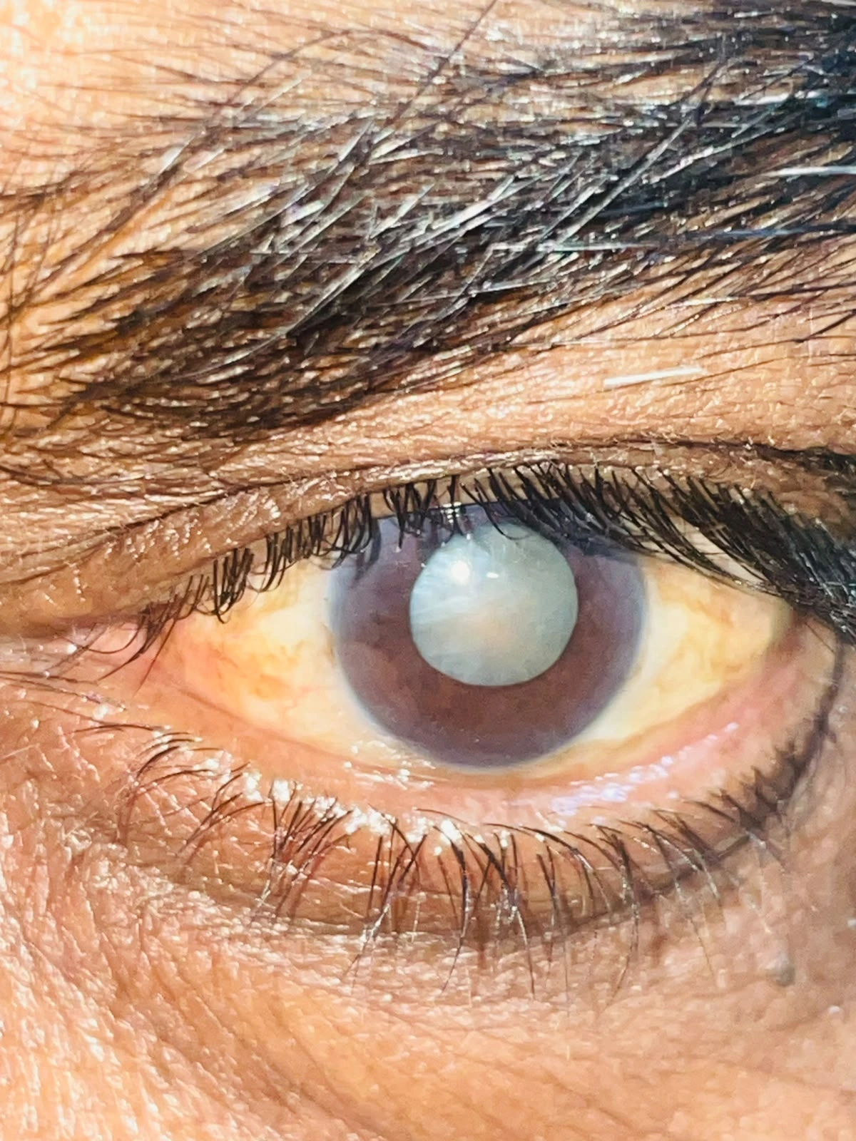 Cataract